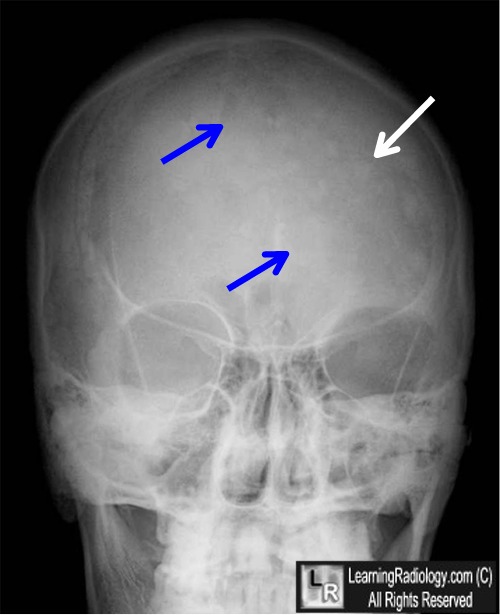 Osteoporosis Circumscripta
